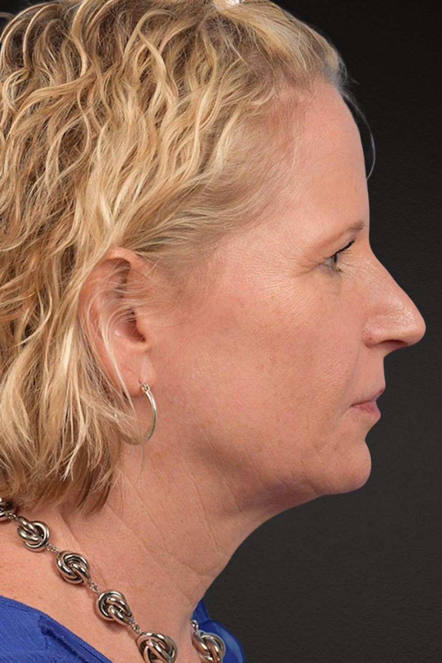 Neck Lift Before & After Gallery - Patient 250758 - Image 9