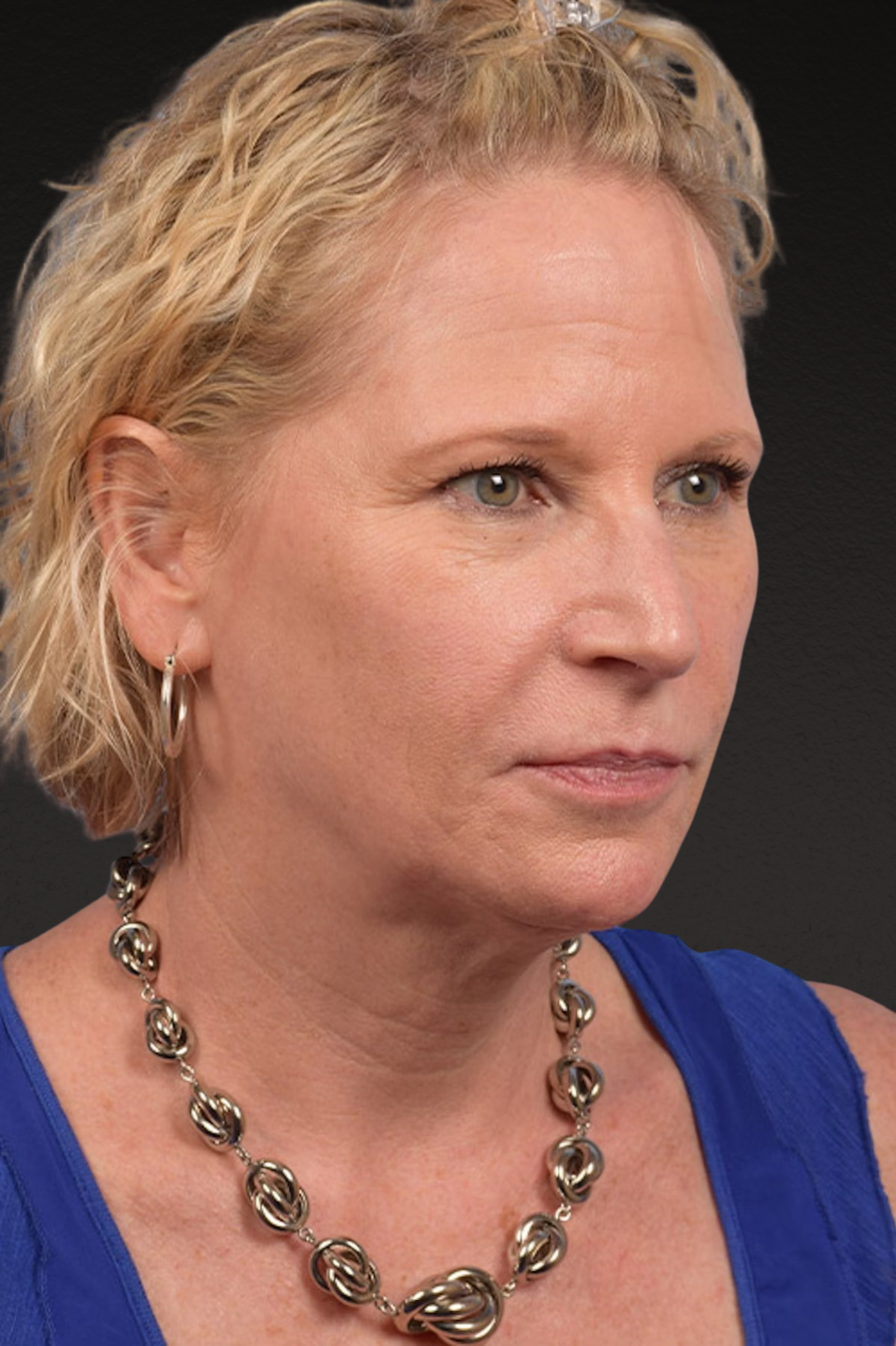 Neck Lift Before & After Gallery - Patient 250758 - Image 7
