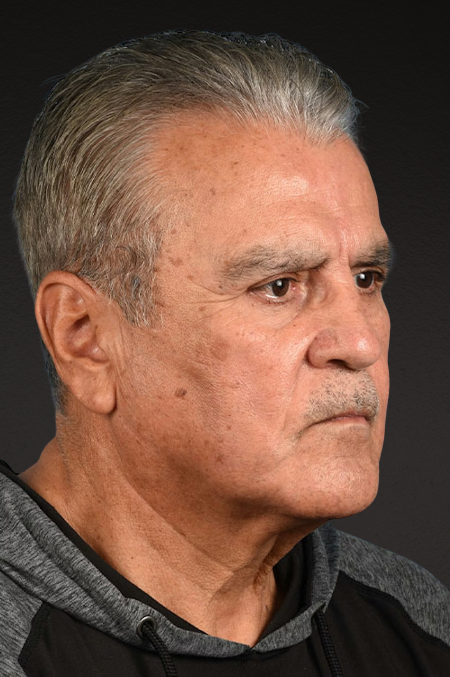 Neck Lift Before & After Gallery - Patient 151912 - Image 1