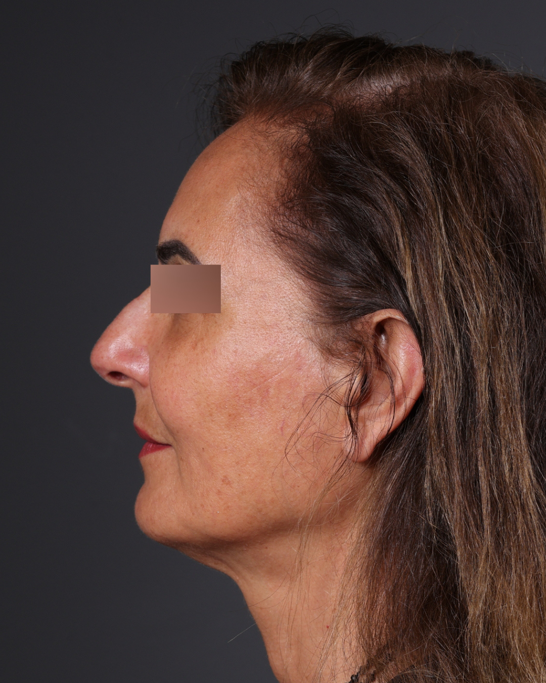 Thread Lifting Before & After Gallery - Patient 573741 - Image 10