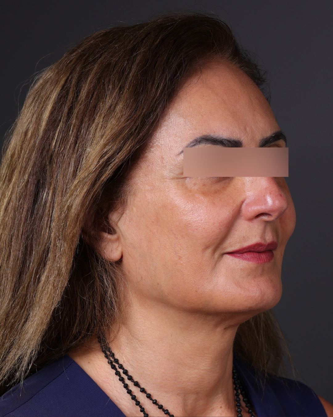 Thread Lifting Before & After Gallery - Patient 573741 - Image 4