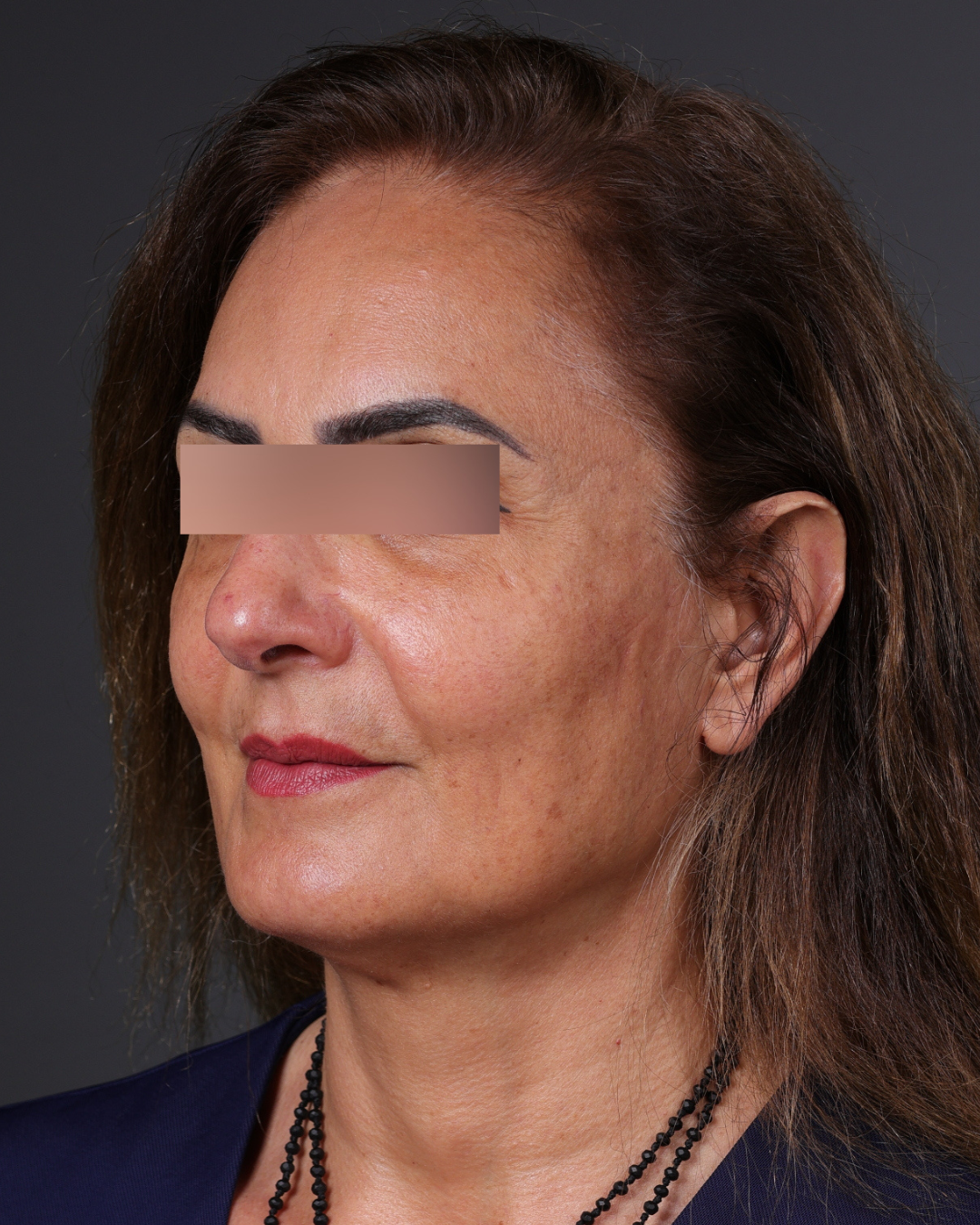 Thread Lifting Before & After Gallery - Patient 573741 - Image 8