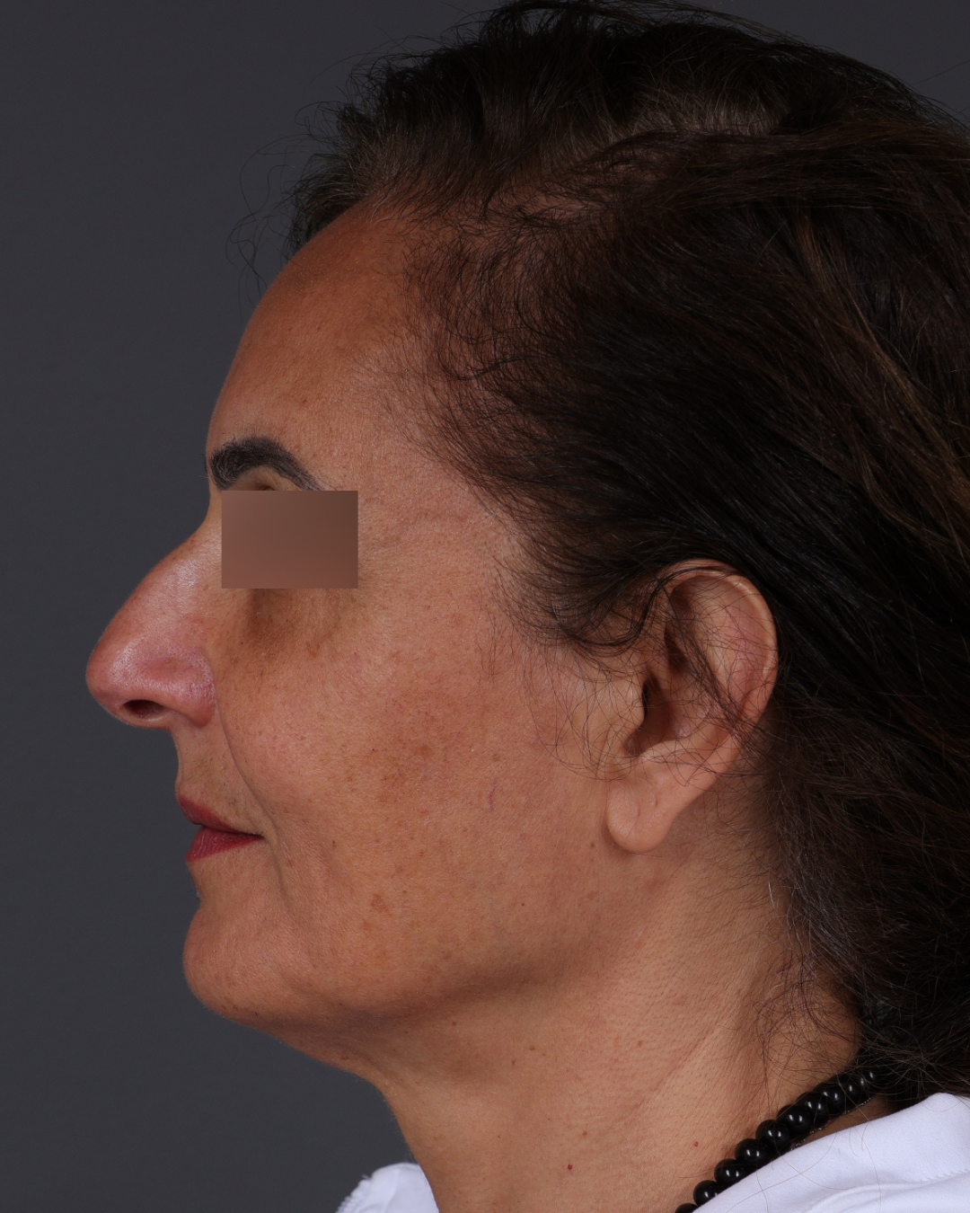 Thread Lifting Before & After Gallery - Patient 573741 - Image 9