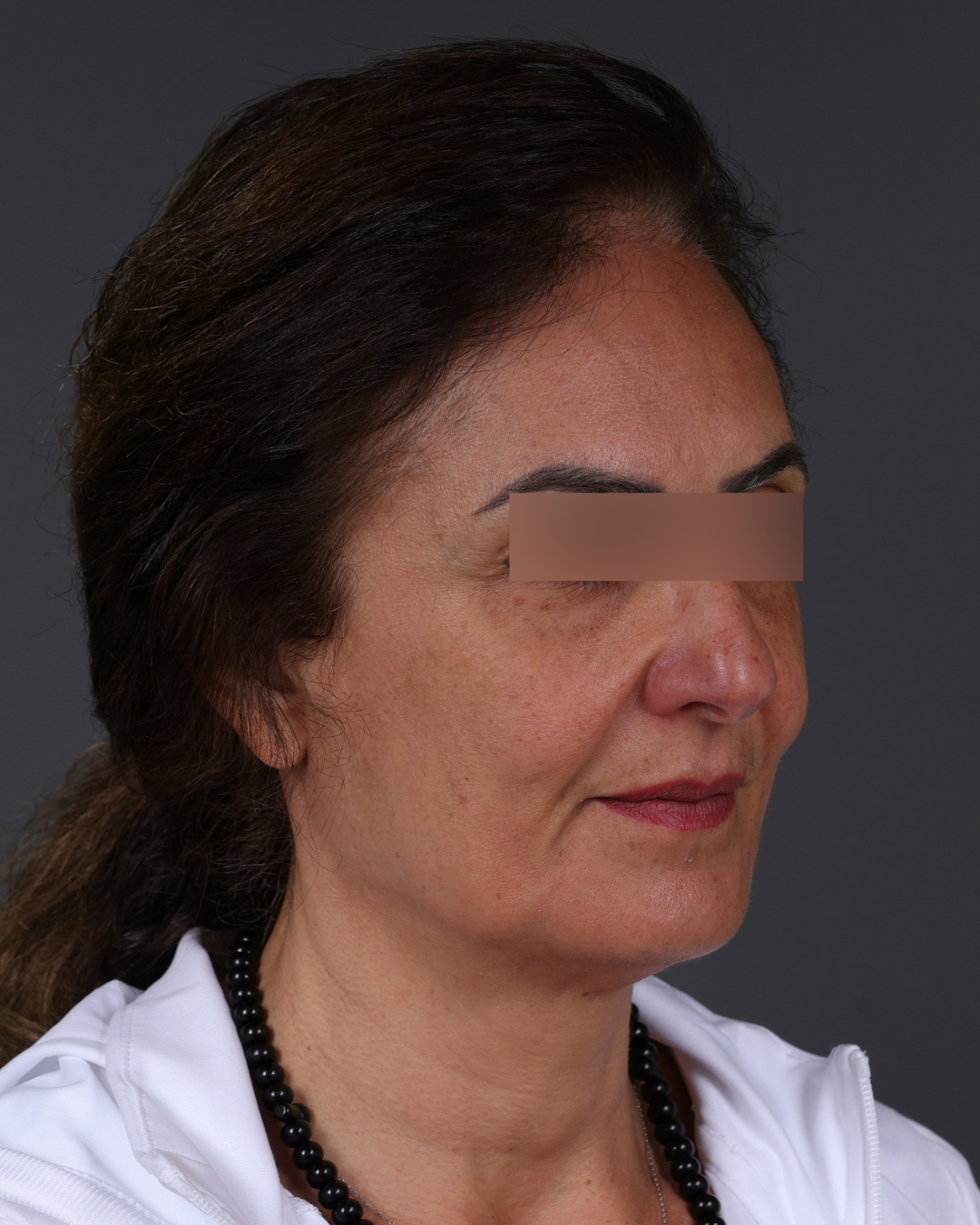 Thread Lifting Before & After Gallery - Patient 573741 - Image 3