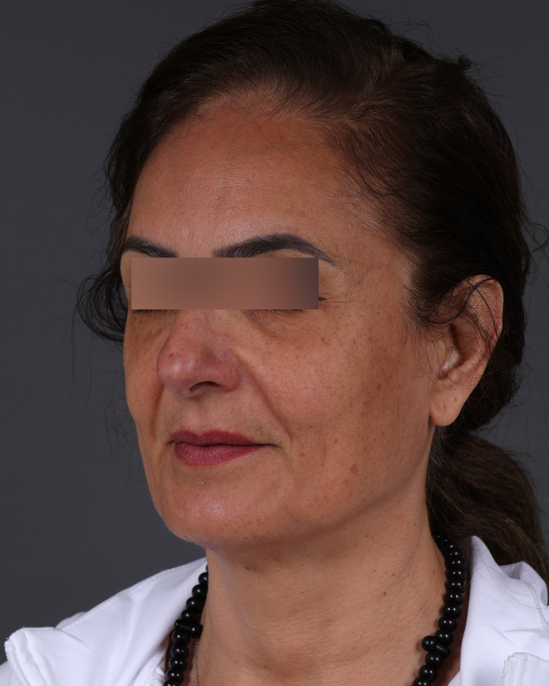 Thread Lifting Before & After Gallery - Patient 573741 - Image 7