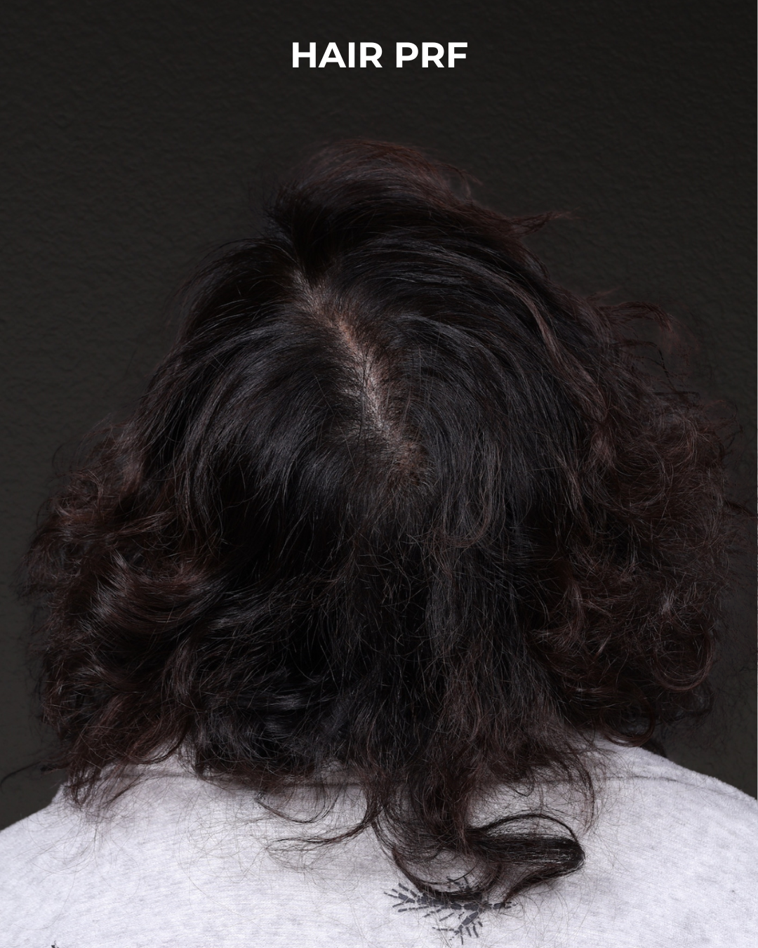 Hair Rejuvenation With PRP Before & After Gallery - Patient 118949 - Image 2
