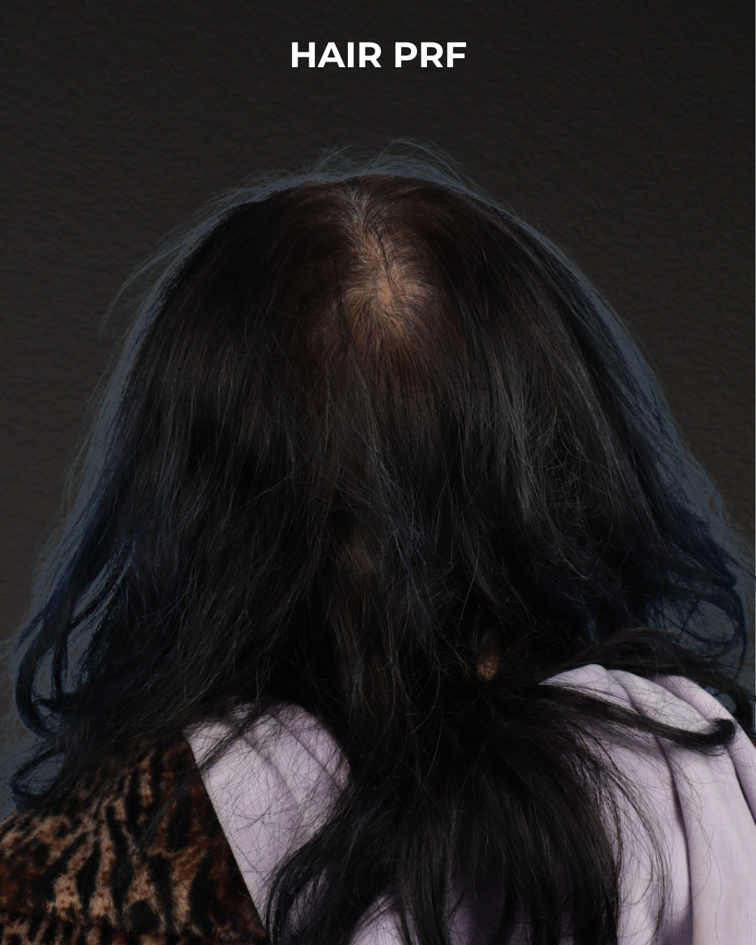 Hair Rejuvenation With PRP Before & After Gallery - Patient 118949 - Image 1