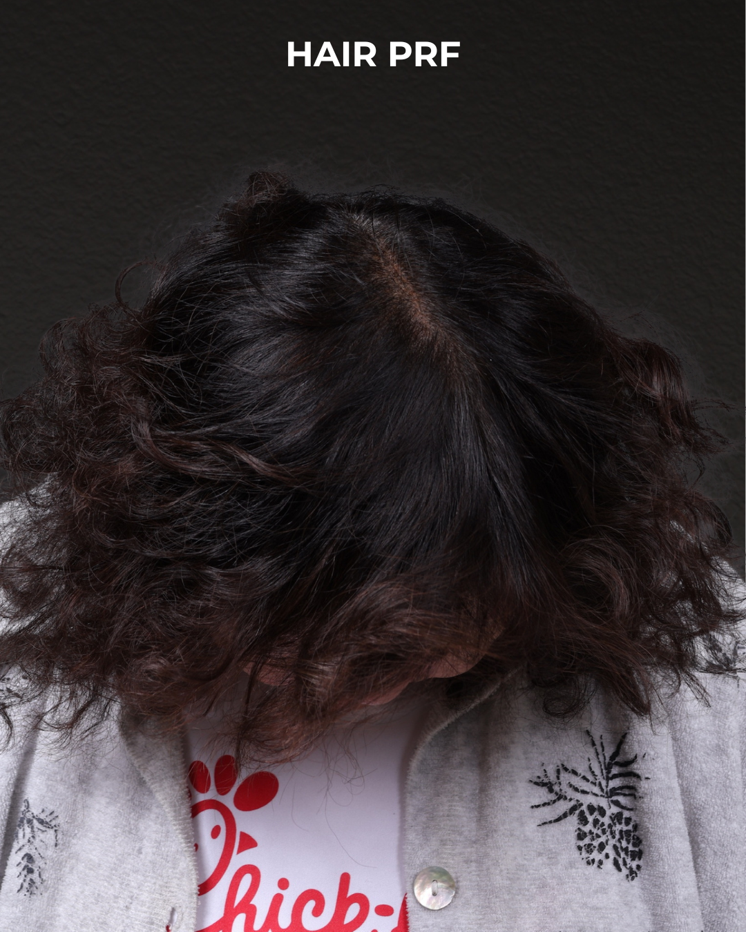 Hair Rejuvenation With PRP Before & After Gallery - Patient 118949 - Image 4