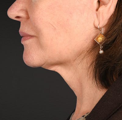 Neck Lift Before & After Gallery - Patient 328488 - Image 2