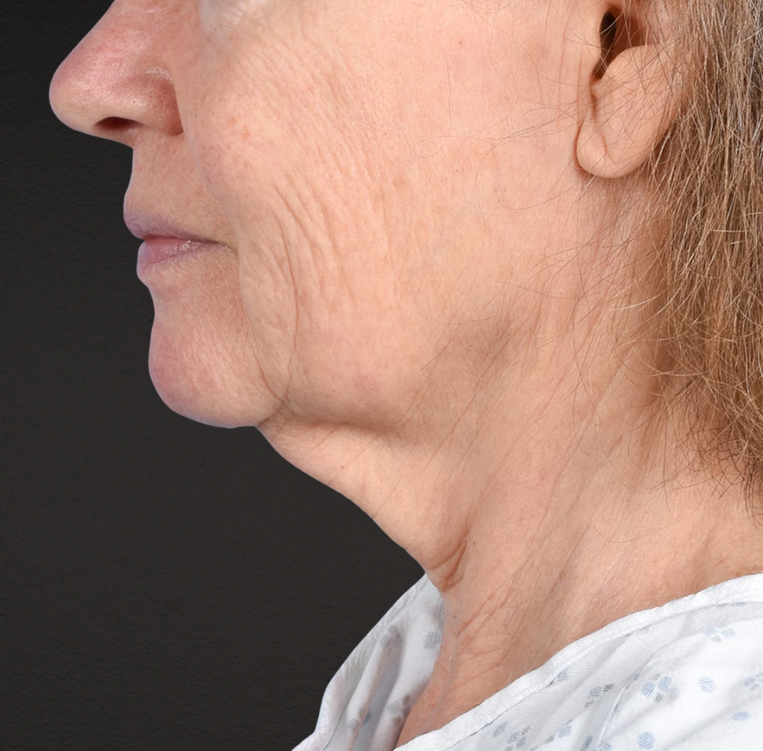 Neck Lift Before & After Gallery - Patient 328488 - Image 1