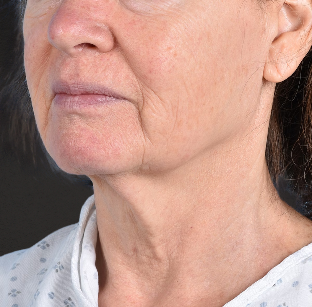 Neck Lift Before & After Gallery - Patient 328488 - Image 3