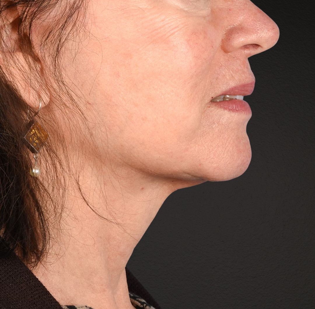 Neck Lift Before & After Gallery - Patient 328488 - Image 8
