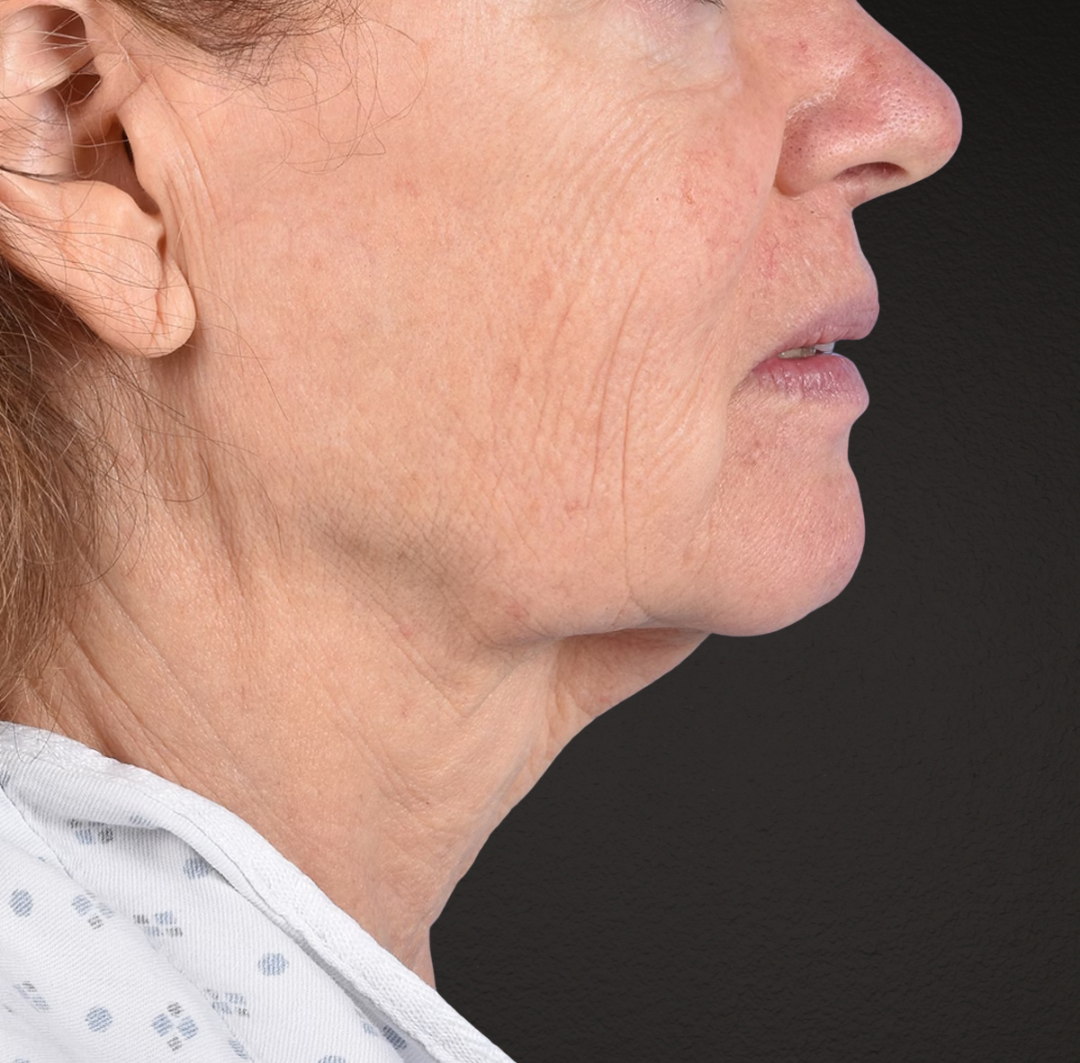 Neck Lift Before & After Gallery - Patient 328488 - Image 7
