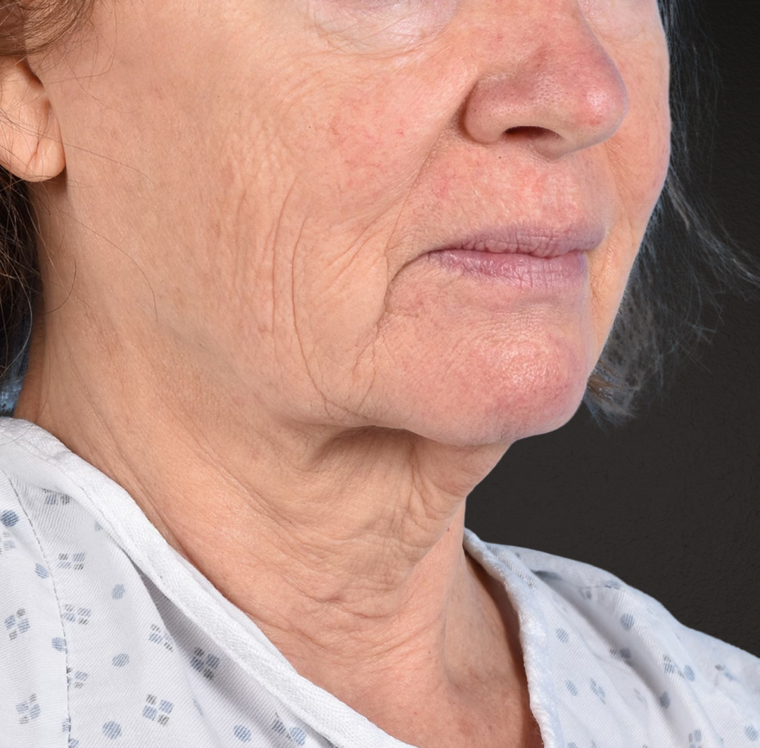 Neck Lift Before & After Gallery - Patient 328488 - Image 5