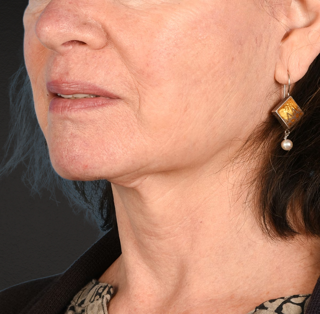 Neck Lift Before & After Gallery - Patient 328488 - Image 4