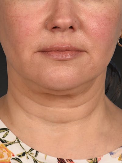 Neck Lift Before & After Gallery - Patient 382090 - Image 1