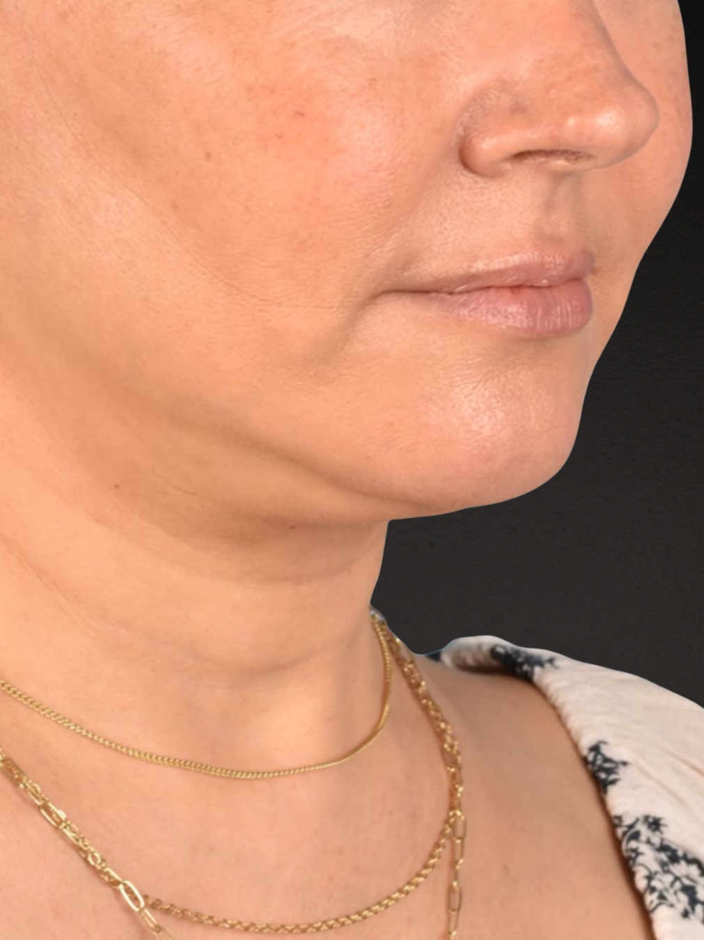 Neck Lift Before & After Gallery - Patient 382090 - Image 4