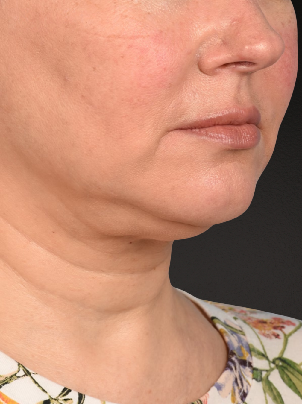 Neck Lift Before & After Gallery - Patient 382090 - Image 3