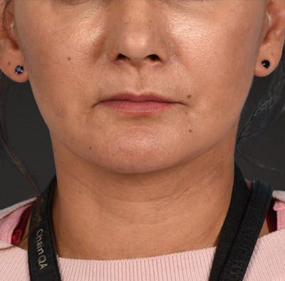 Neck Lift Before & After Gallery - Patient 424030 - Image 2