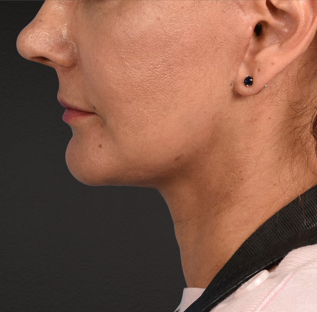 Neck Lift Before & After Gallery - Patient 424030 - Image 8