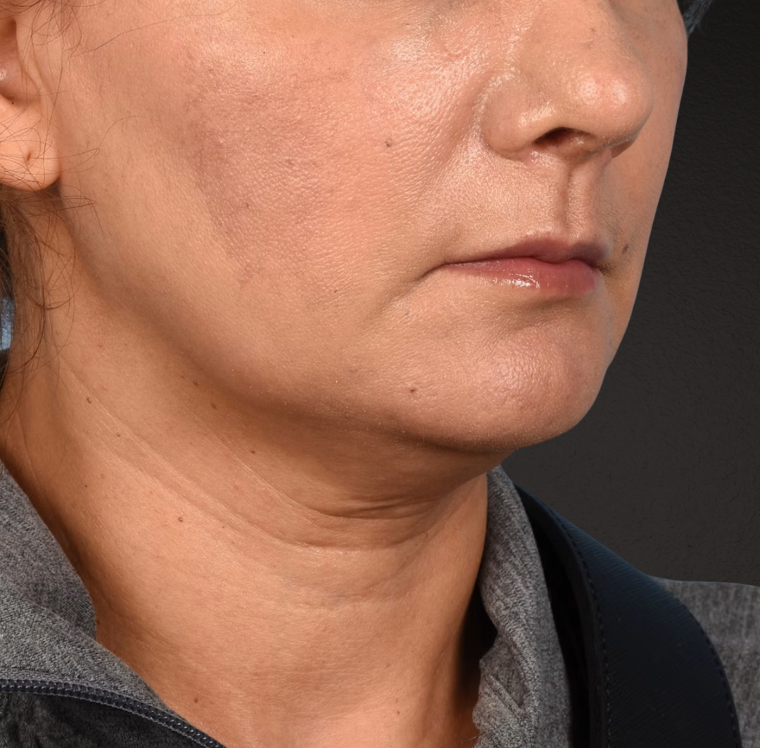 Neck Lift Before & After Gallery - Patient 424030 - Image 3