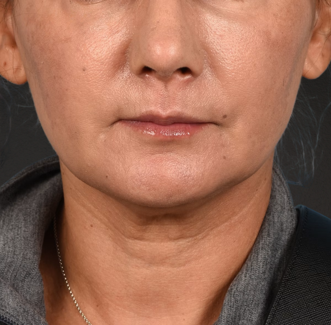 Neck Lift Before & After Gallery - Patient 424030 - Image 1