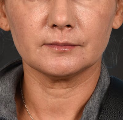 Neck Lift Before & After Gallery - Patient 424030 - Image 1