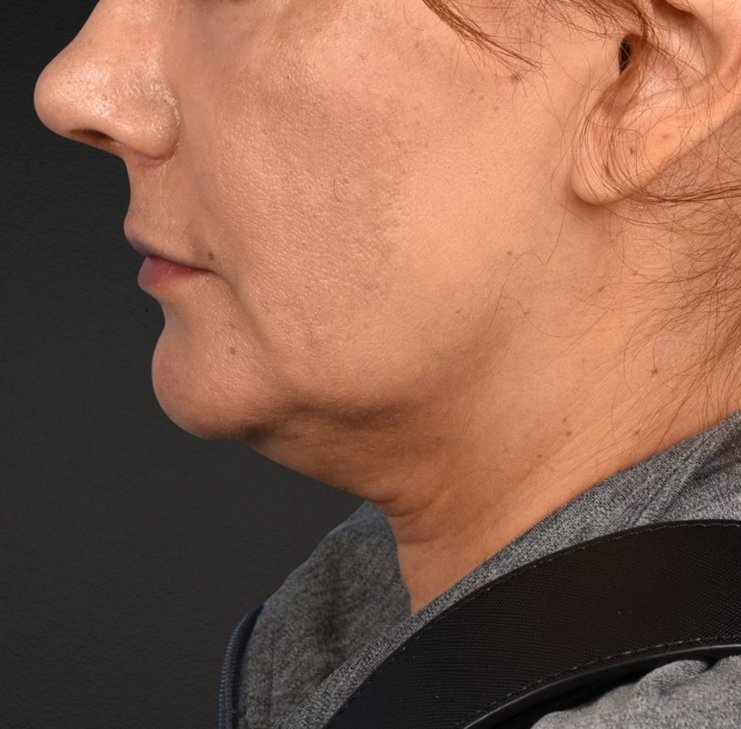 Neck Lift Before & After Gallery - Patient 424030 - Image 7