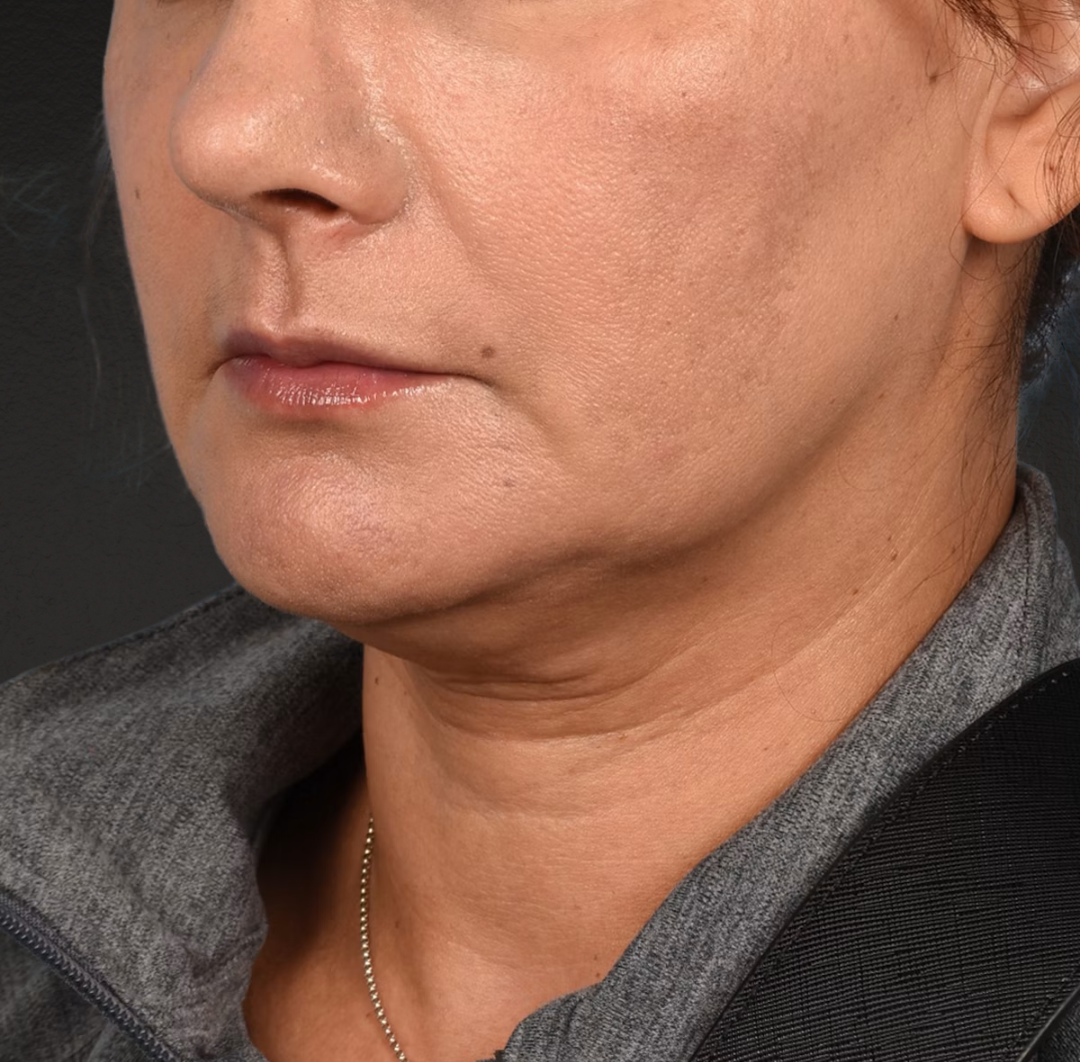 Neck Lift Before & After Gallery - Patient 424030 - Image 5
