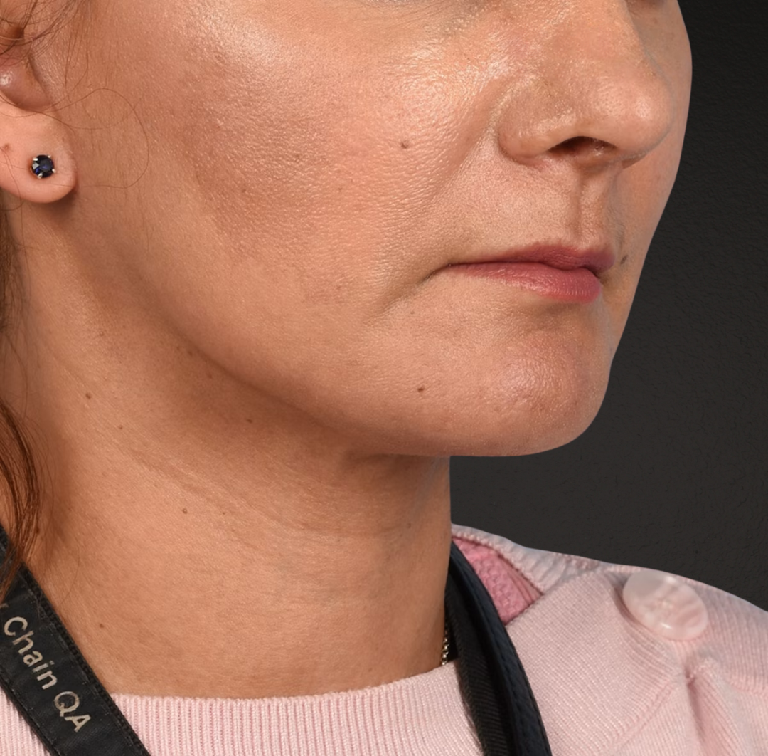Neck Lift Before & After Gallery - Patient 424030 - Image 4