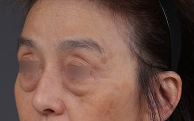 Blepharoplasty Before & After Gallery - Patient 189111 - Image 1