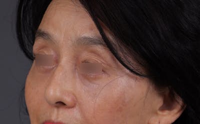 Blepharoplasty Before & After Gallery - Patient 189111 - Image 2