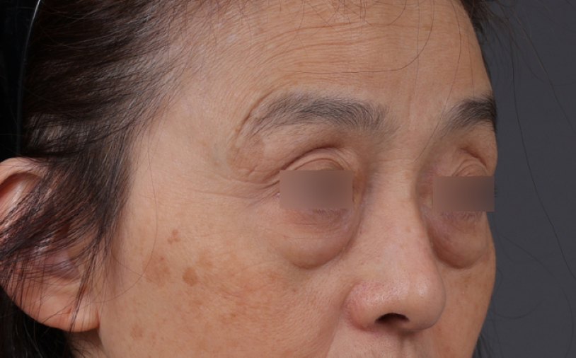 Blepharoplasty Before & After Gallery - Patient 189111 - Image 3