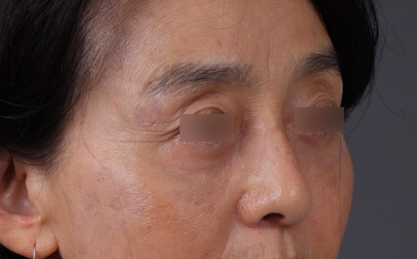 Blepharoplasty Before & After Gallery - Patient 189111 - Image 4