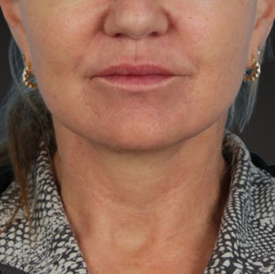Neck Lift Before & After Gallery - Patient 278784 - Image 2