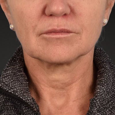 Neck Lift Before & After Gallery - Patient 278784 - Image 1