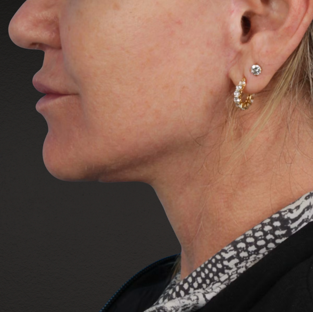 Neck Lift Before & After Gallery - Patient 278784 - Image 6