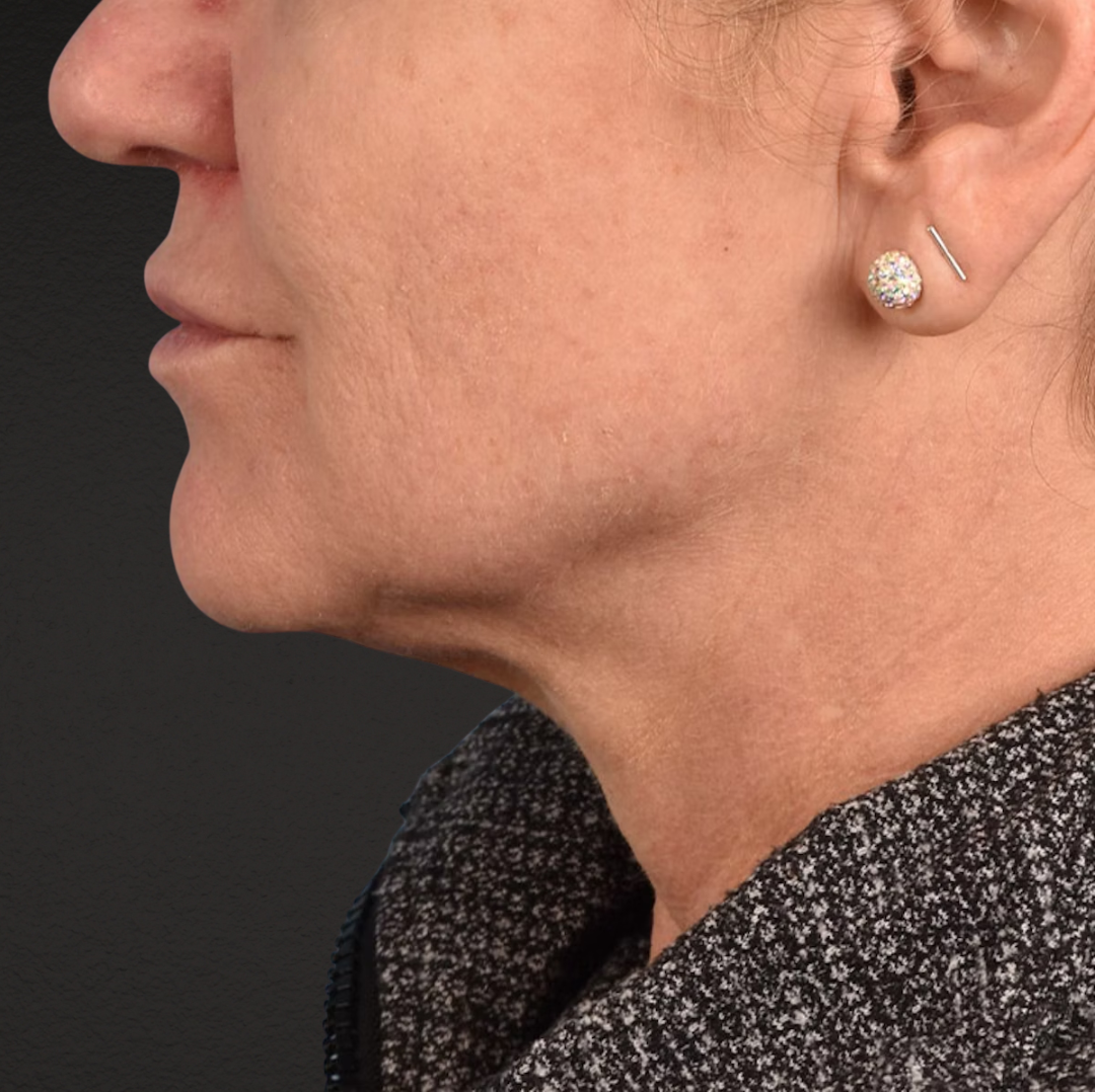 Neck Lift Before & After Gallery - Patient 278784 - Image 5