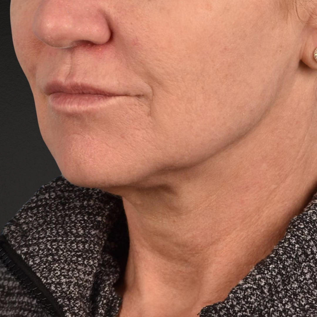 Neck Lift Before & After Gallery - Patient 278784 - Image 3