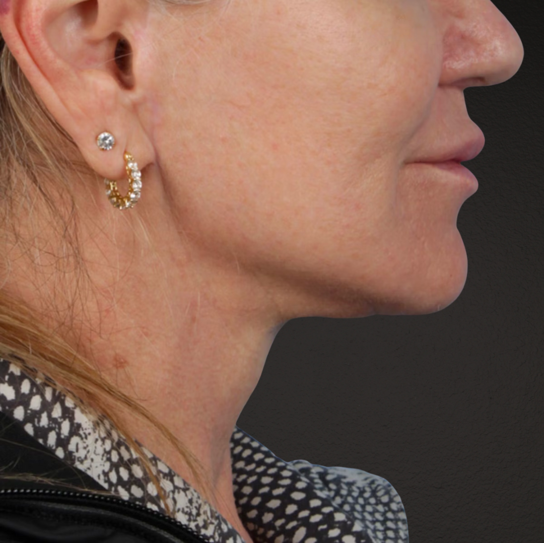 Neck Lift Before & After Gallery - Patient 278784 - Image 10