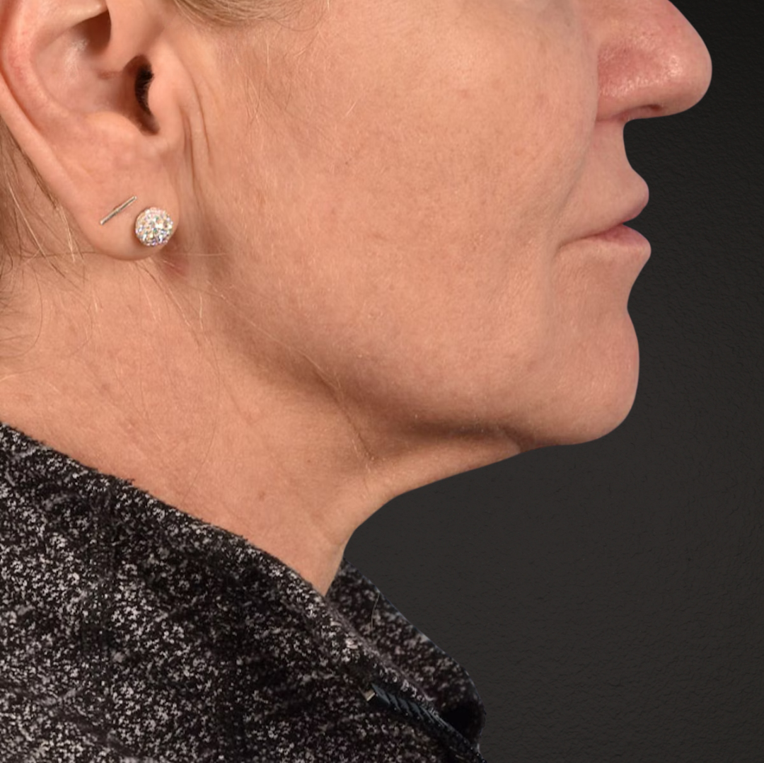 Neck Lift Before & After Gallery - Patient 278784 - Image 9