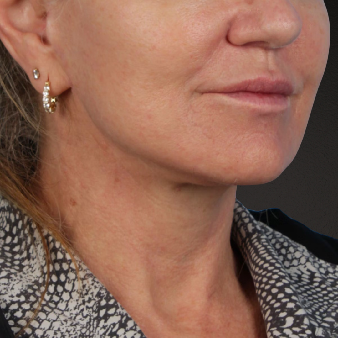 Neck Lift Before & After Gallery - Patient 278784 - Image 8