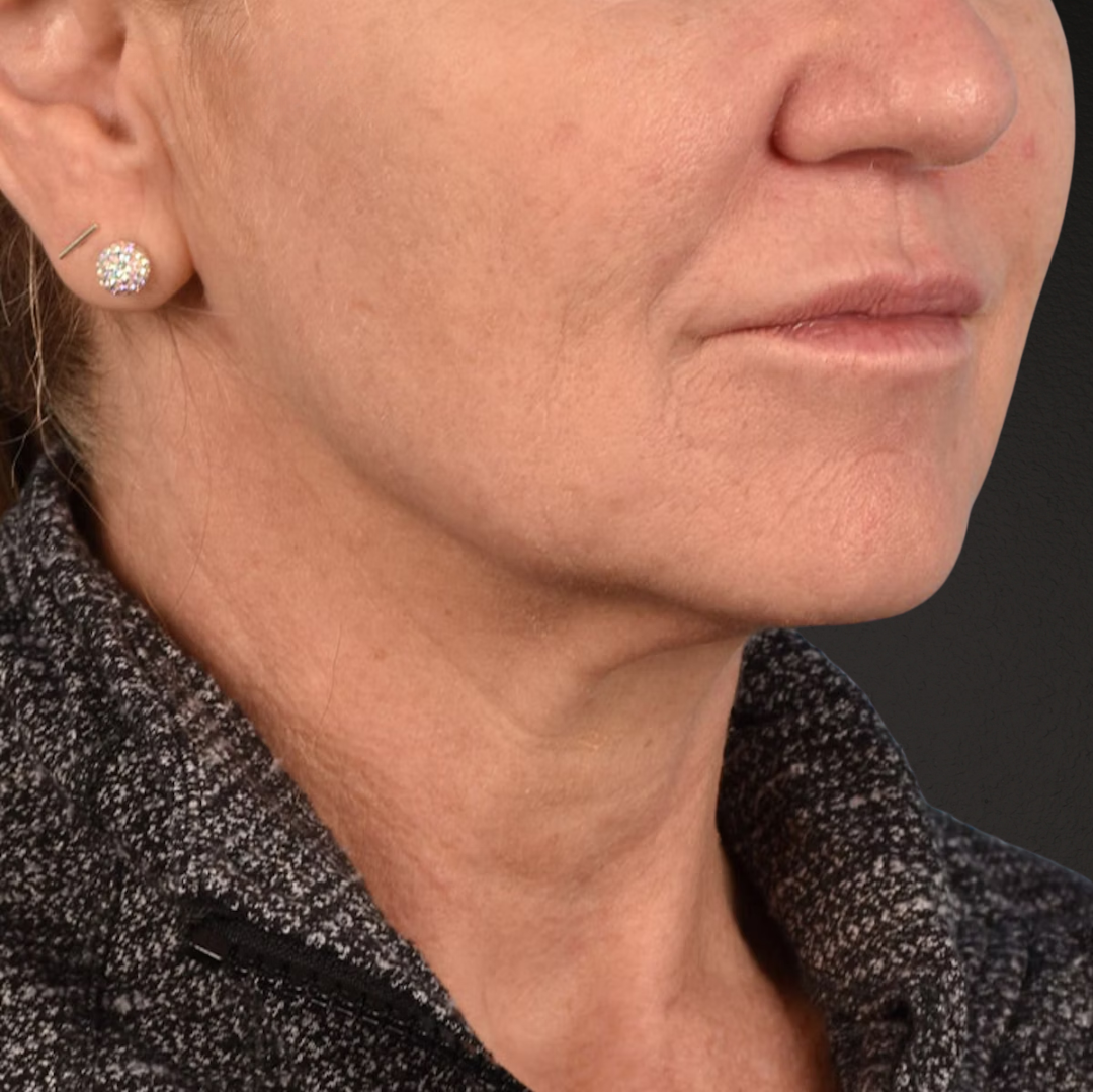 Neck Lift Before & After Gallery - Patient 278784 - Image 7