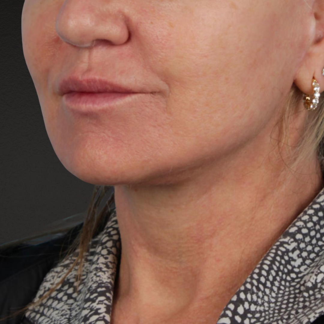 Neck Lift Before & After Gallery - Patient 278784 - Image 4