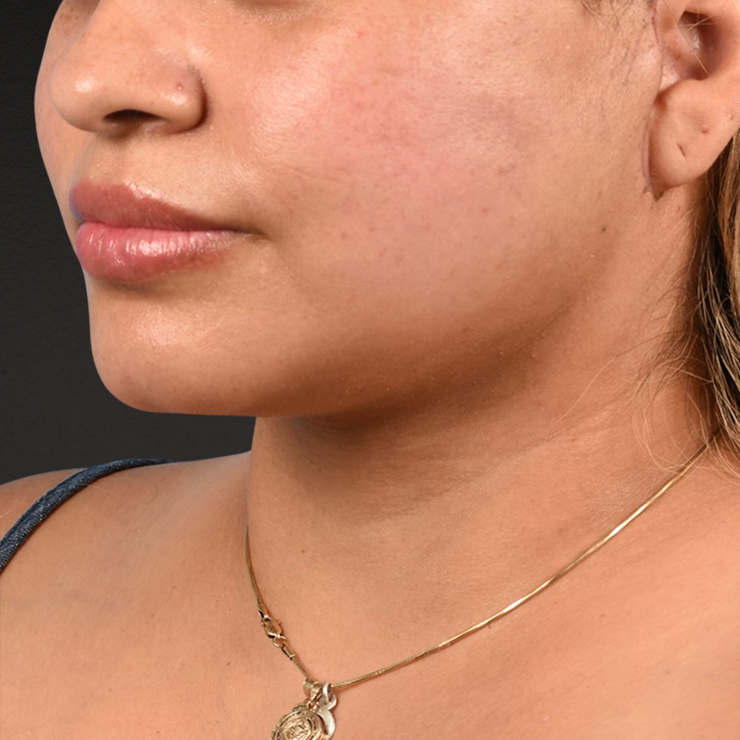 Neck Lift Before & After Gallery - Patient 776486 - Image 1