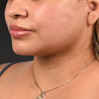 Neck Lift Before & After Gallery - Patient 776486 - Image 1