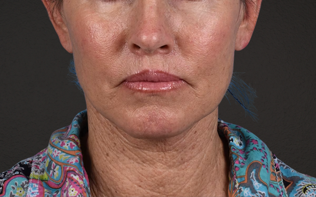 Neck Lift Before & After Gallery - Patient 540880 - Image 2