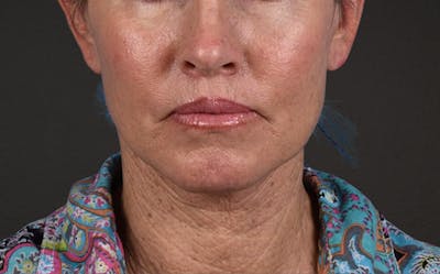 Neck Lift Before & After Gallery - Patient 540880 - Image 2