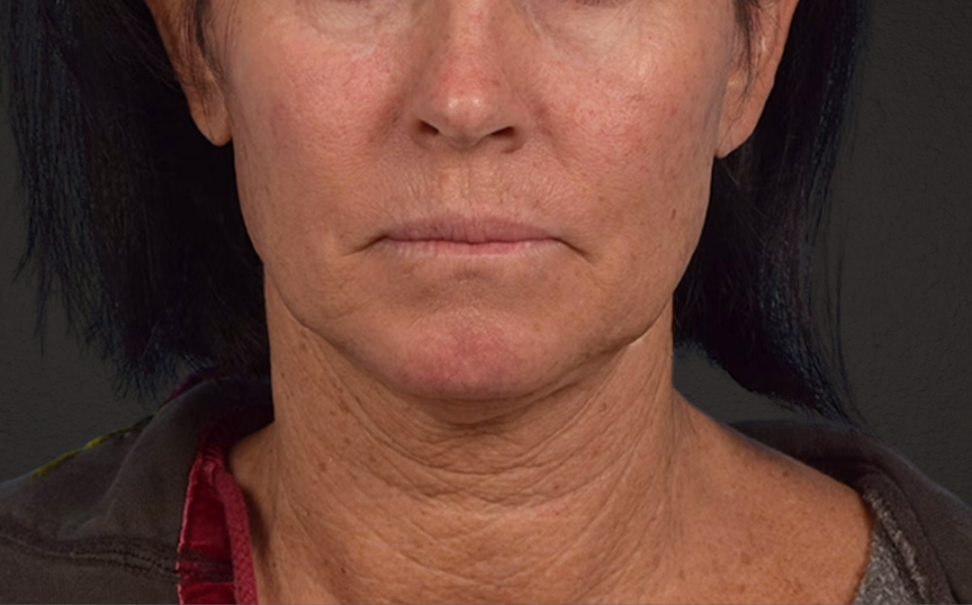 Neck Lift Before & After Gallery - Patient 540880 - Image 1