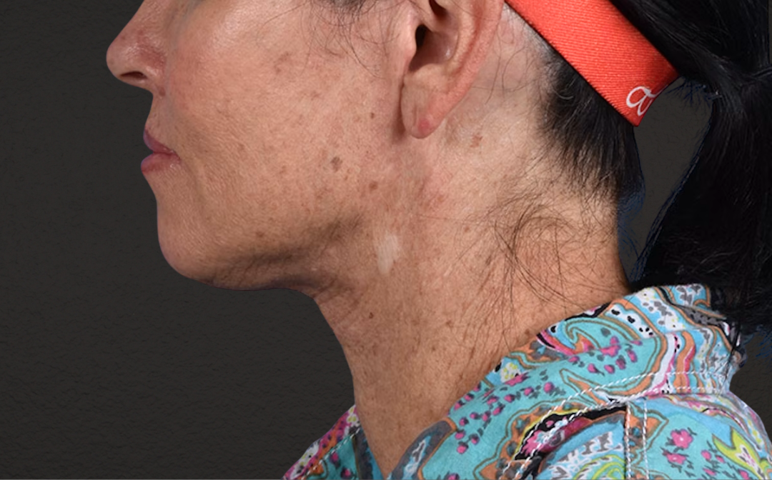 Neck Lift Before & After Gallery - Patient 540880 - Image 6